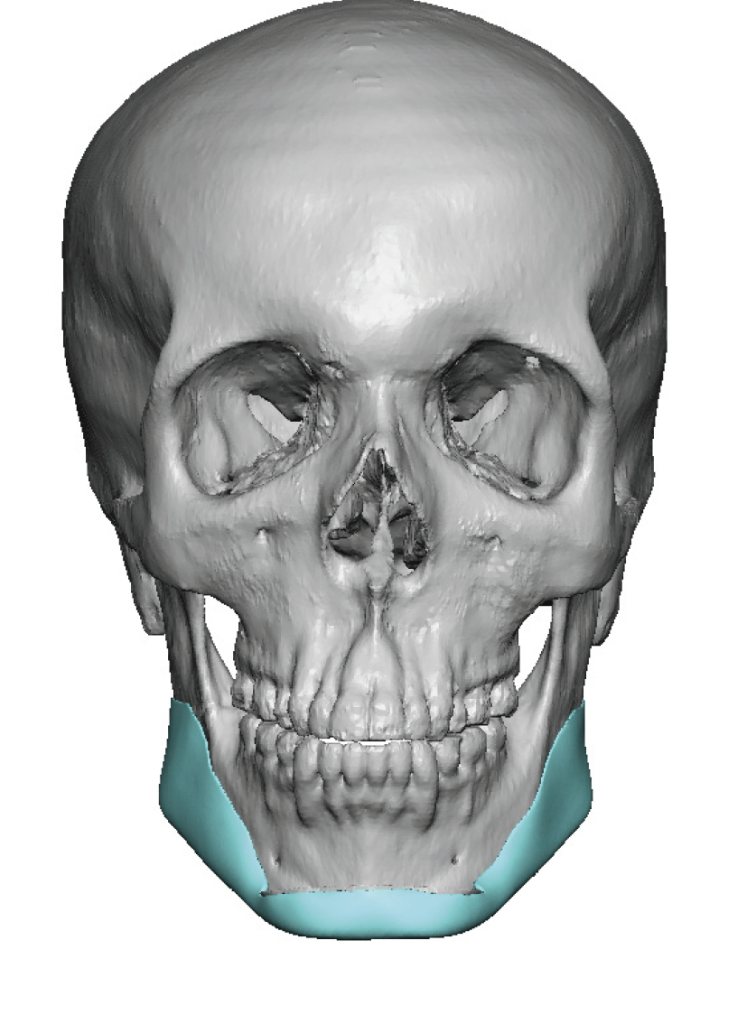 Plastic Surgery Case Study - Reshaping/Derotating The Steep Mandibular ...