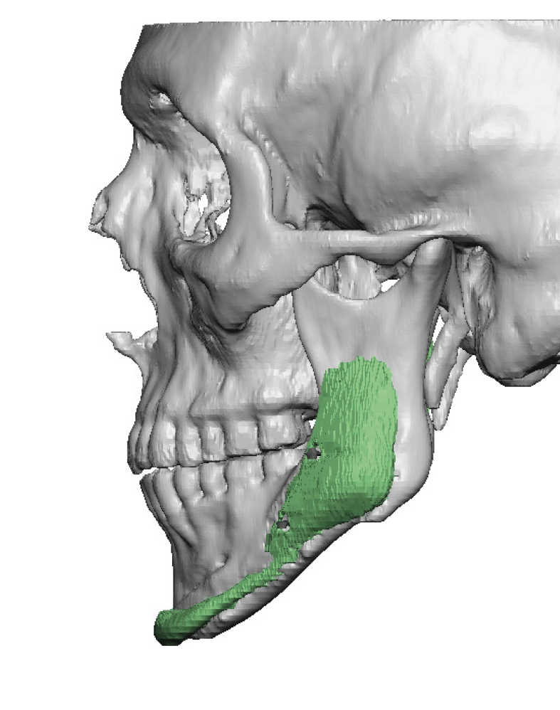 Plastic Surgery Case Study - Custom Jawline Implant Replacement For 