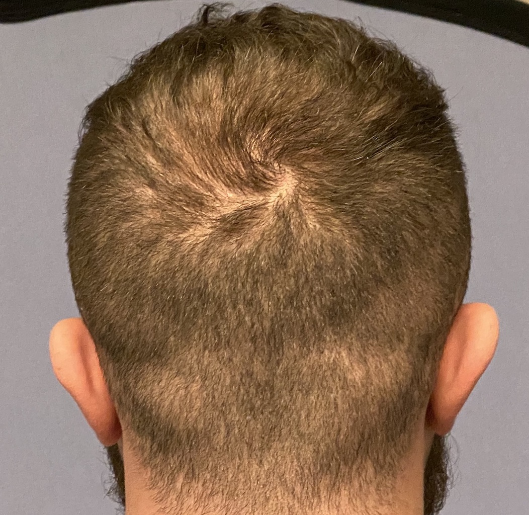 Plastic Surgery Case Study Reduction of the Wide/Convex Side of the