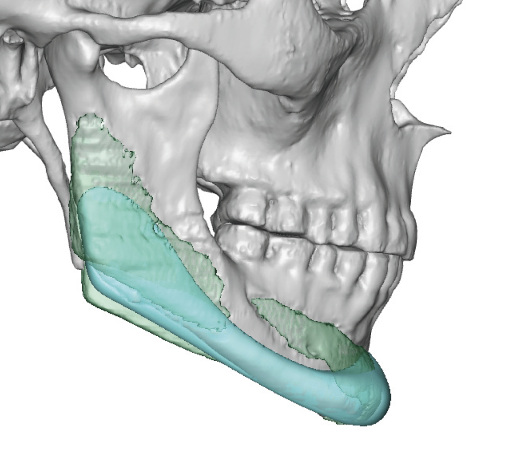 Plastic Surgery Case Study The Different Effects Of Standard Vs Custom Jaw Implants In Male