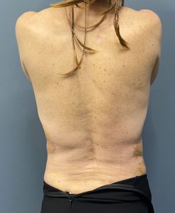 Plastic Surgery Case Study - The Early Recovery and Effects from Rib  Removal Waistline Narrowing Surgery - Explore Plastic Surgery