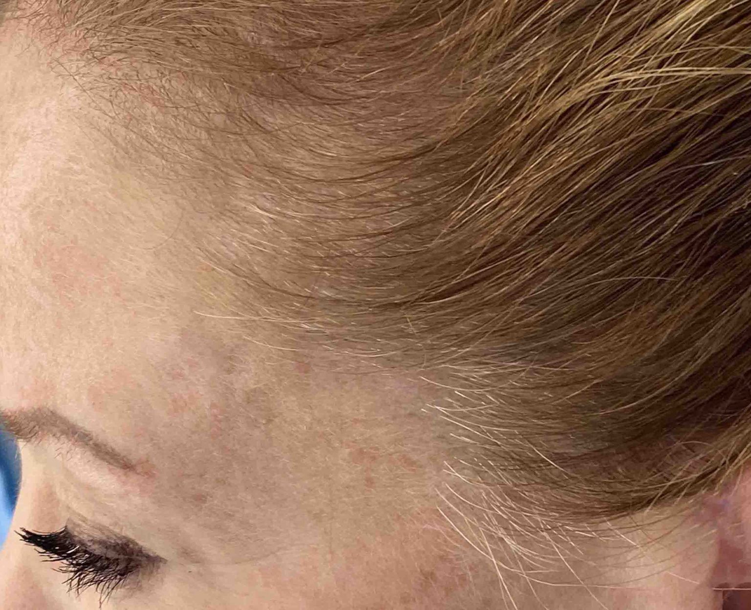 The Long-Term Outcome of the Incisions/Scars from Temporal Ligation ...