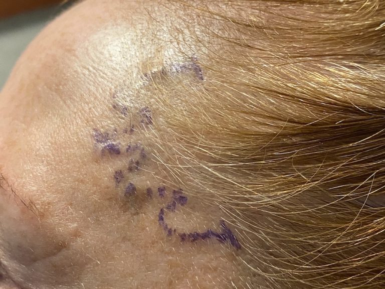 The Long-Term Outcome of the Incisions/Scars from Temporal Ligation ...