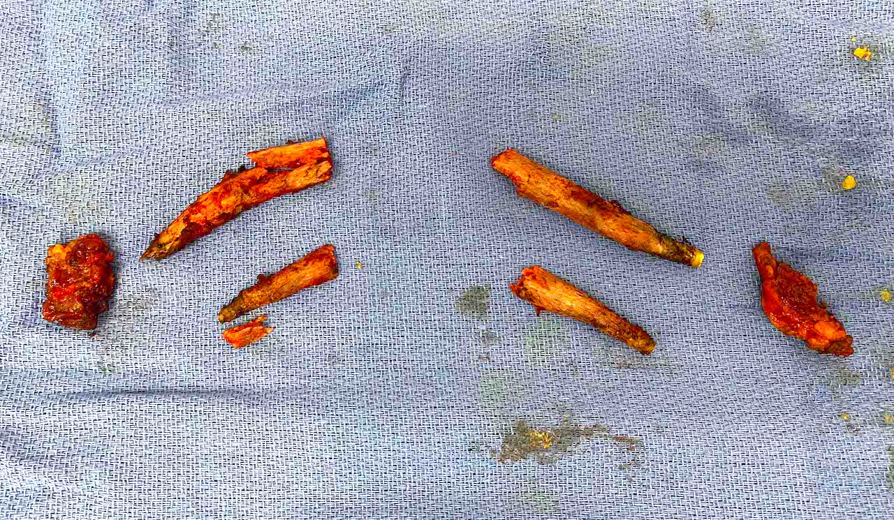 Plastic Surgery Case Study Combination Rib Removal and Buttock Implant Surgery For Improvement