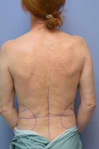 Plastic Surgery Case Study - Waist Reduction In A Female Body Builder Using  Combined Rib Removal and Lat Muscle Resection - Explore Plastic Surgery