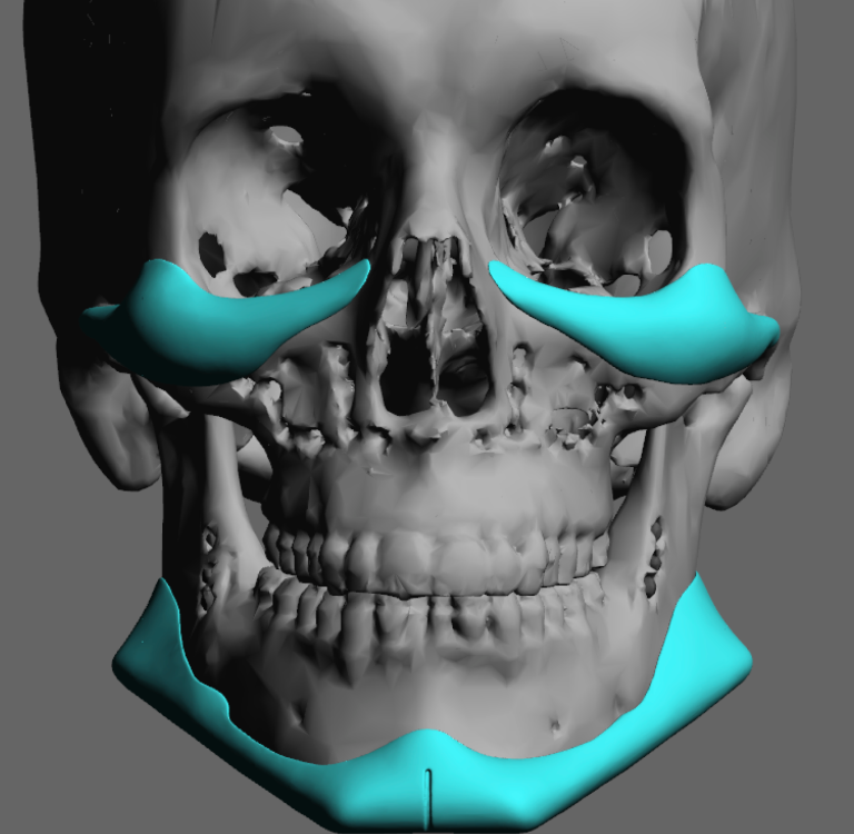 Surgical Placement of Male Custom Infraorbital-Malar and Jawline ...