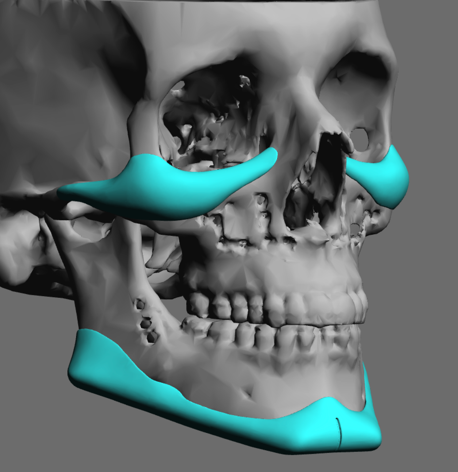 Surgical Placement of Male Custom InfraorbitalMalar and Jawline Implants (Facial