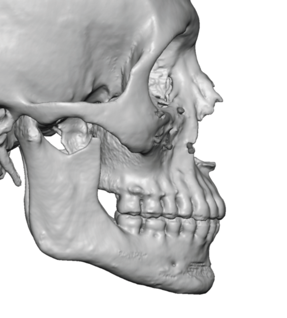 male vertical jaw deficiency side vew 3D CT scan Dr Barry Eppley ...