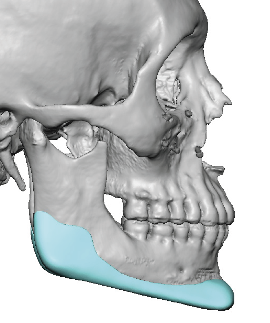 male vertical lengthening jawline implant design side view Dr Barry ...