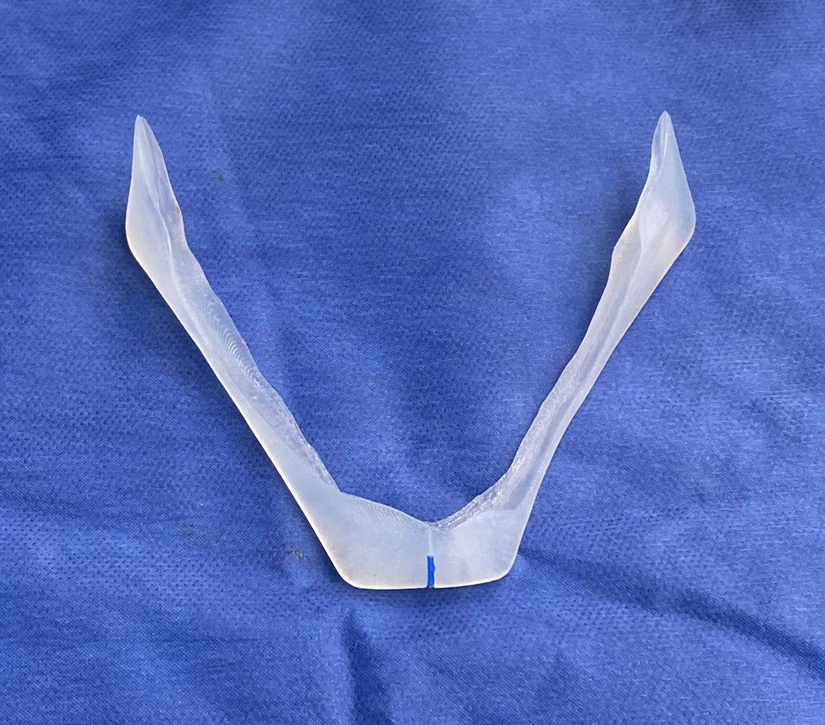 Plastic Surgery Case Study - The Necklifting Effect of The Vertical ...