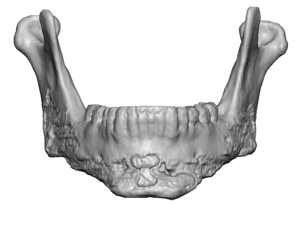 Hydroxyapatite Bone Cement Jaw Augmentation Creates Bone Imprinting ...