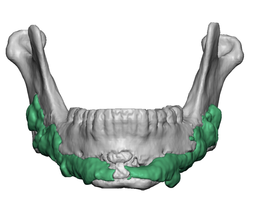 Hydroxyapatite Bone Cement Jaw Augmentation Creates Bone Imprinting ...