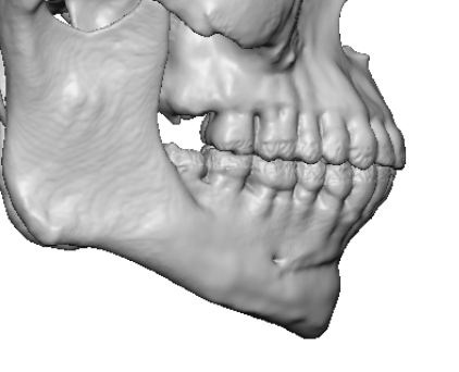 3D Assessment of Chin Implant Imprinting and Bone Overgrowth - Explore ...