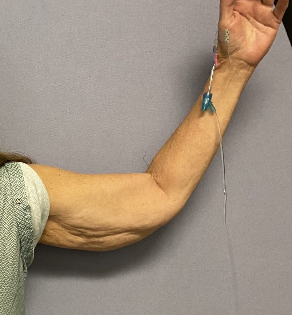 Plastic Surgery Case Study The Fasciocutaneous Flap Method For Major