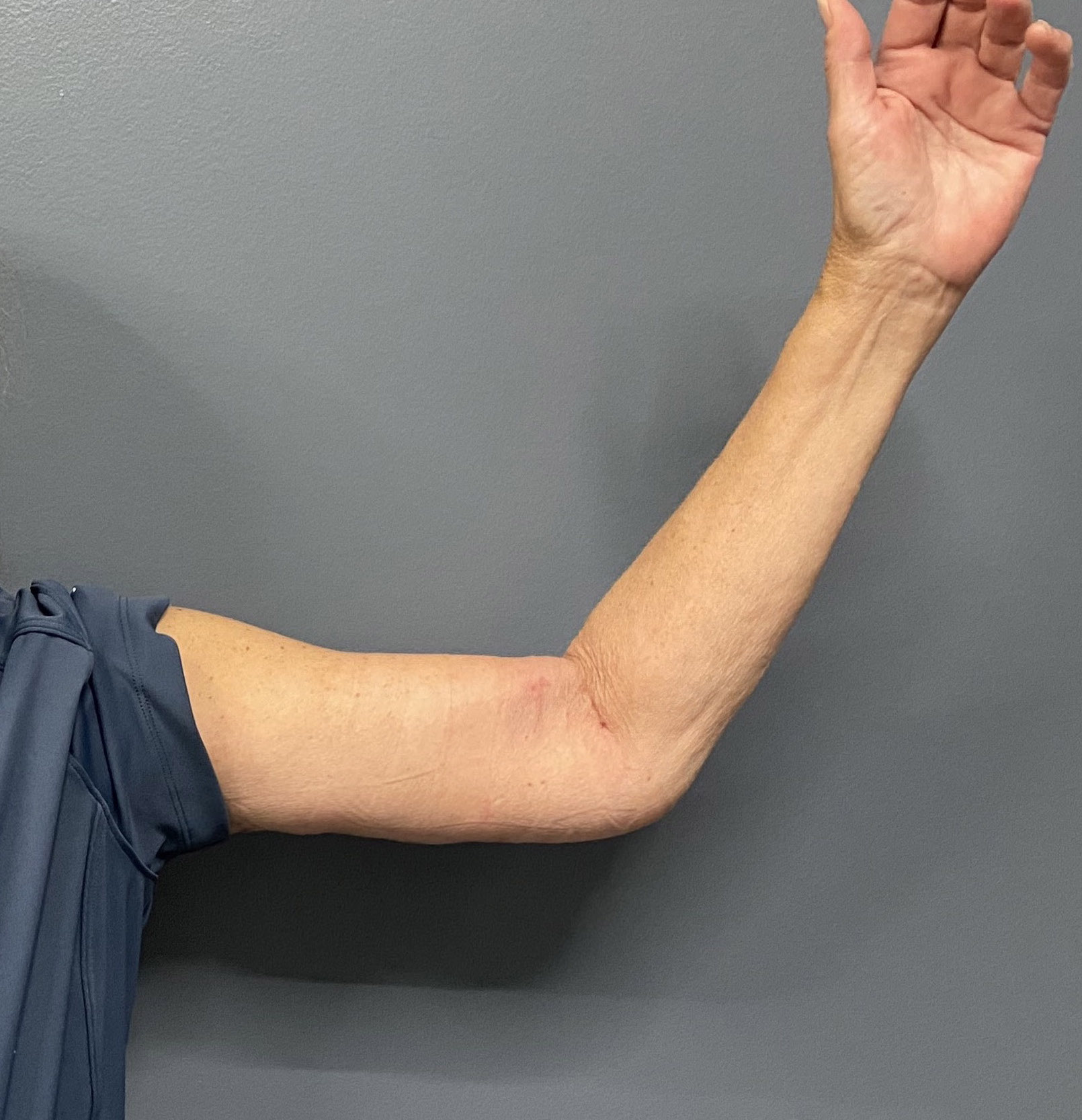 Plastic Surgery Case Study The Fasciocutaneous Flap Method For Major