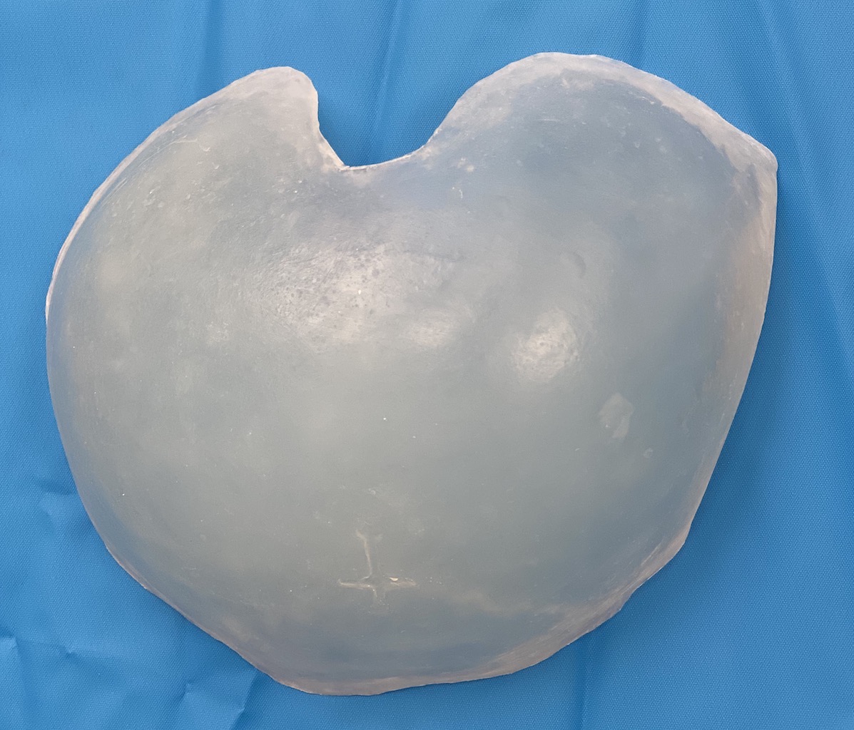 Plastic Surgery Case Study Custom Skull Implant for the Male Crown of the Head (Posterior