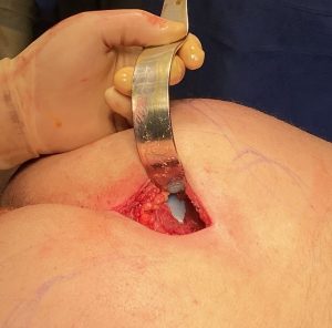 Plastic Surgery Case Study - Male Buttock Augmentation with 400cc  Intramuscular Implants - Explore Plastic Surgery