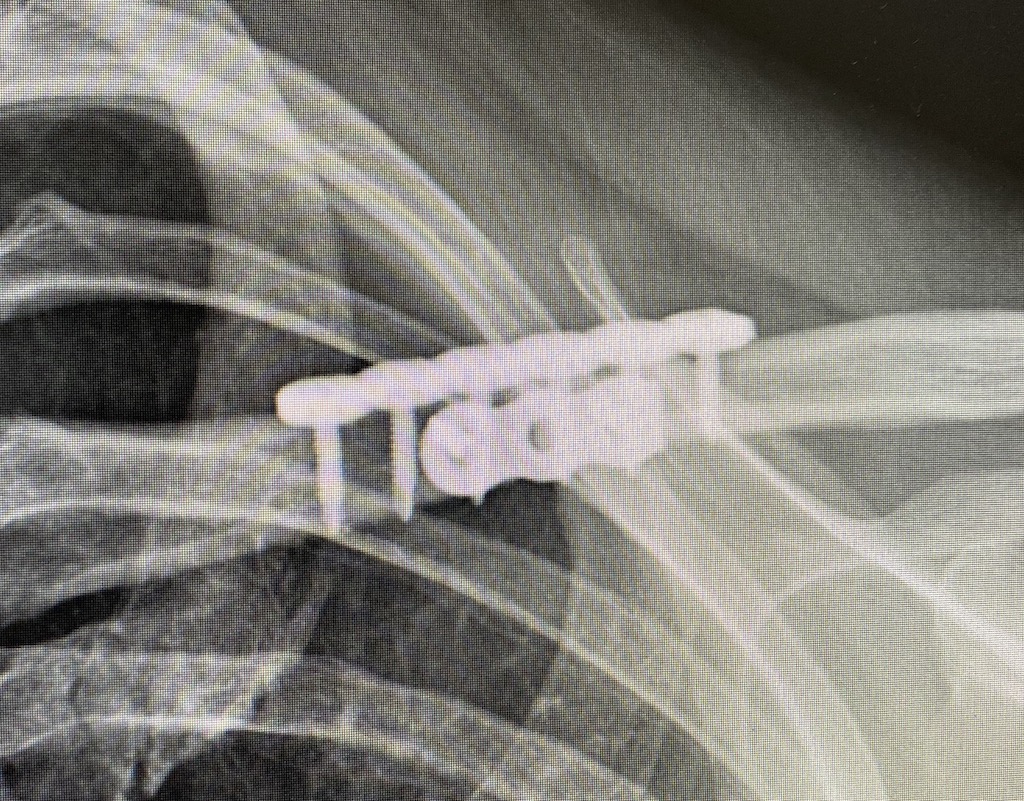 Male vs Female Bony Anatomic Differences in Shoulder Reduction Surgery Explore Plastic Surgery