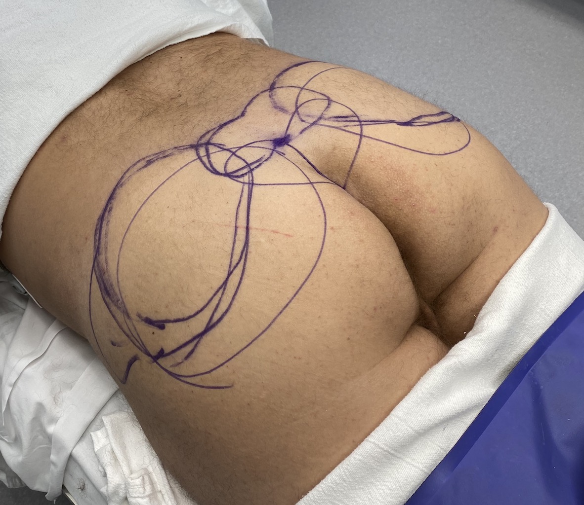 Buttock enhancement : Buttock Dr Ballieux, plastic surgery specialist