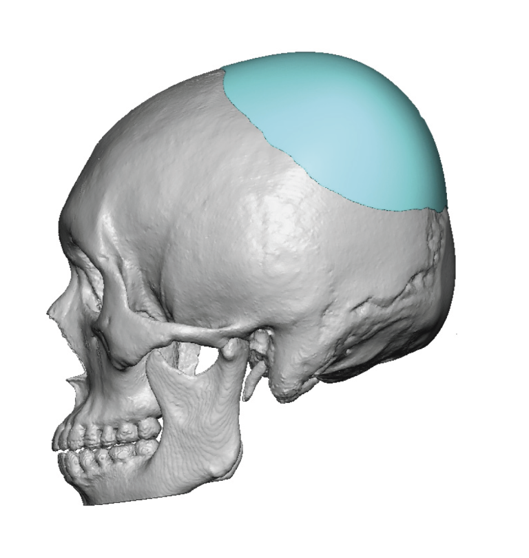Plastic Surgery Case Study - Dual Back of The Head Reshaping with ...