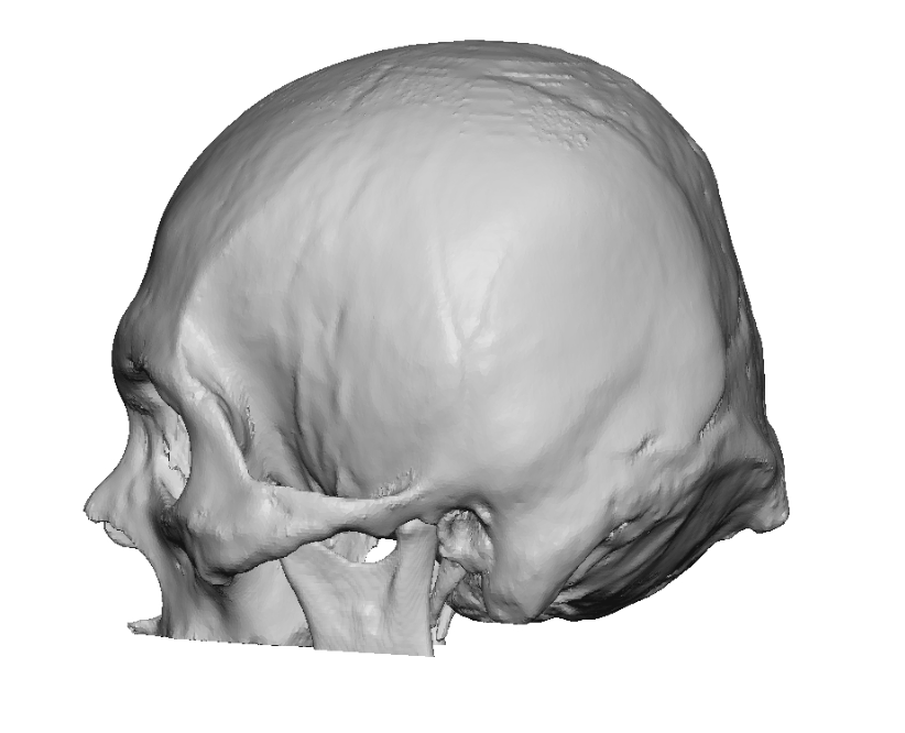 Plastic Surgery Case Study - Lengthening The Brachycephalic Head Shape ...