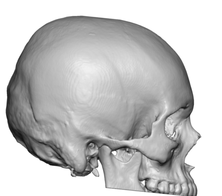 Plastic Surgery Case Study - Top of the Head Skull Reduction For ...