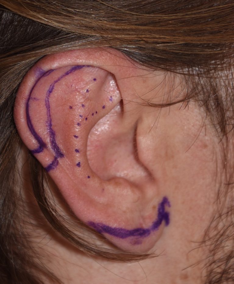 the-long-term-scar-results-from-macrotia-reduction-vertical-ear