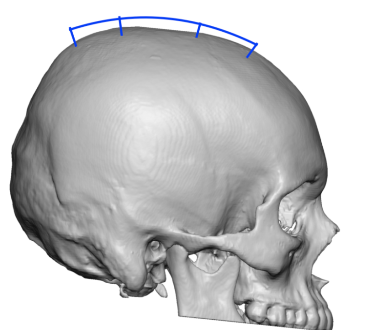 Plastic Surgery Case Study Top of the Head Skull Reduction For Improved Profile Shape