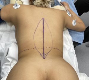 Plastic Surgery Case Study - The Braline Backlift for Removal of Back Rolls  - Explore Plastic Surgery