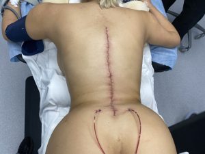 Plastic Surgery Case Study - The Vertical Backlift for Waistline