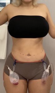 Plastic Surgery Case Study - The Vertical Backlift for Waistline