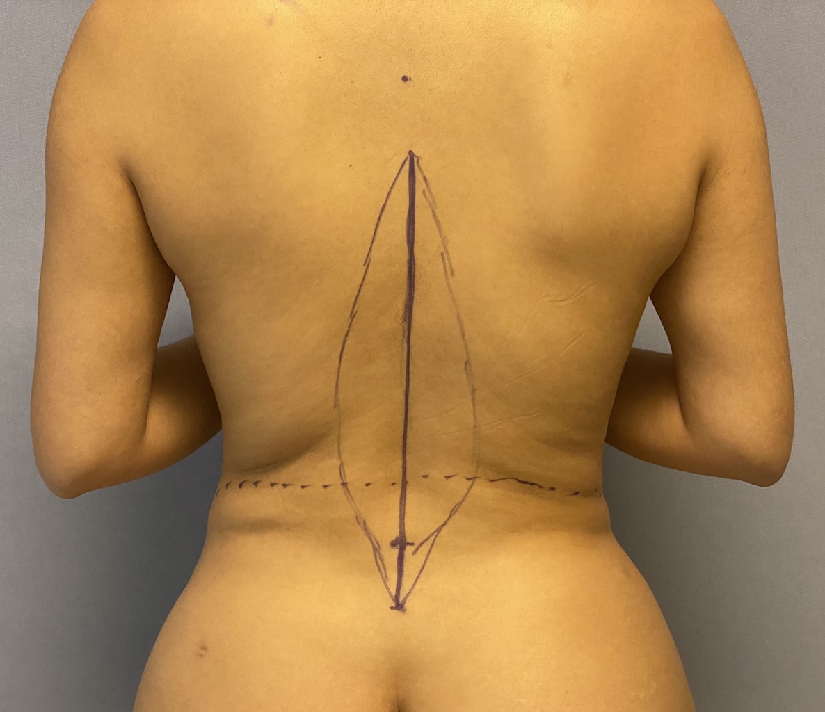 Plastic Surgery Case Study - The Vertical Backlift for Waistline