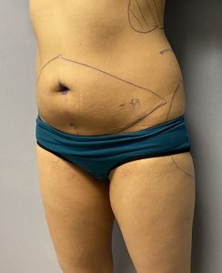 Hip Dip Fat Transfer - Reforme Medical