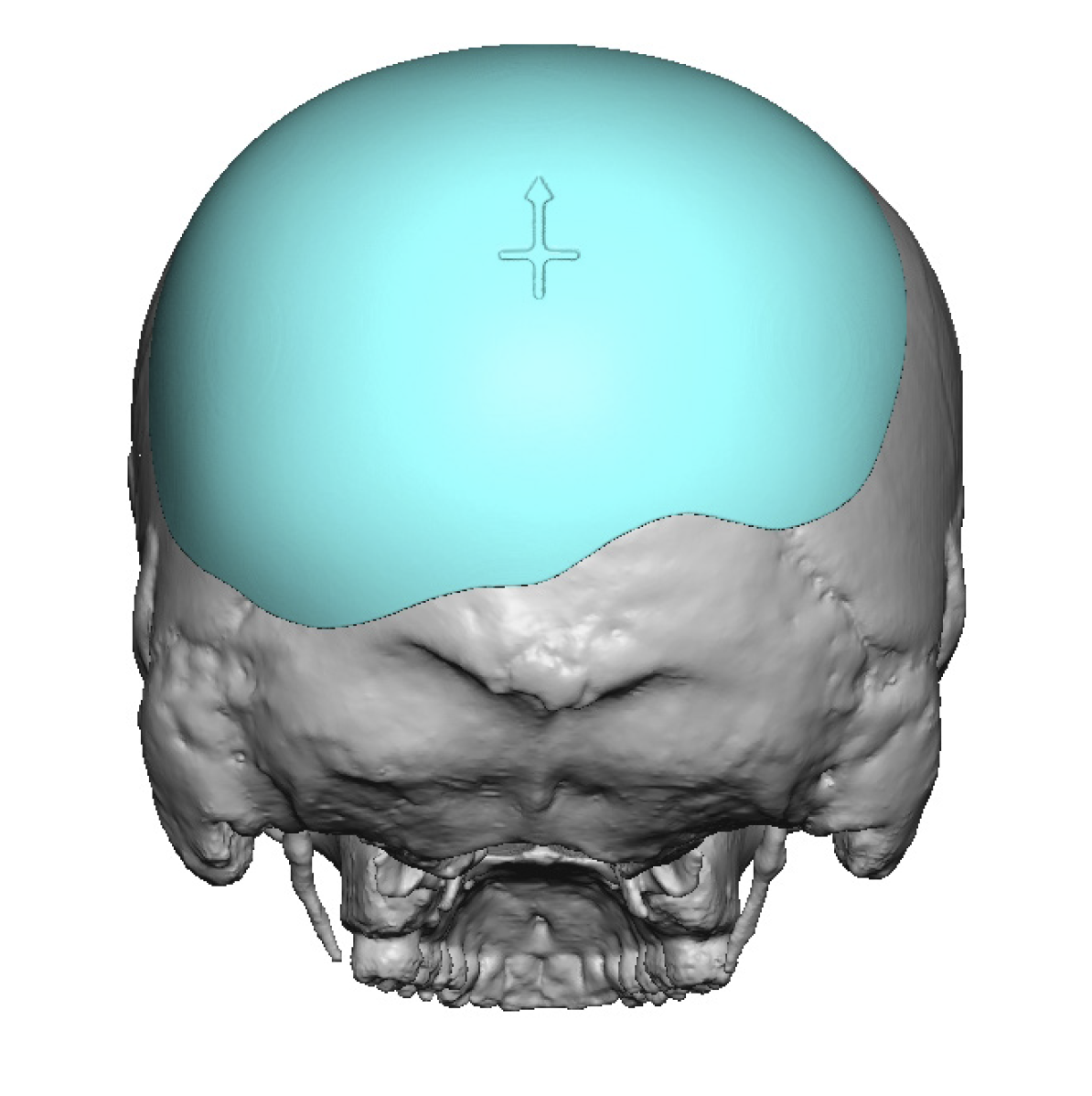 Custom Back Of The Head Skull Implant Design Back View Dr Barry Eppley Indianapolis 