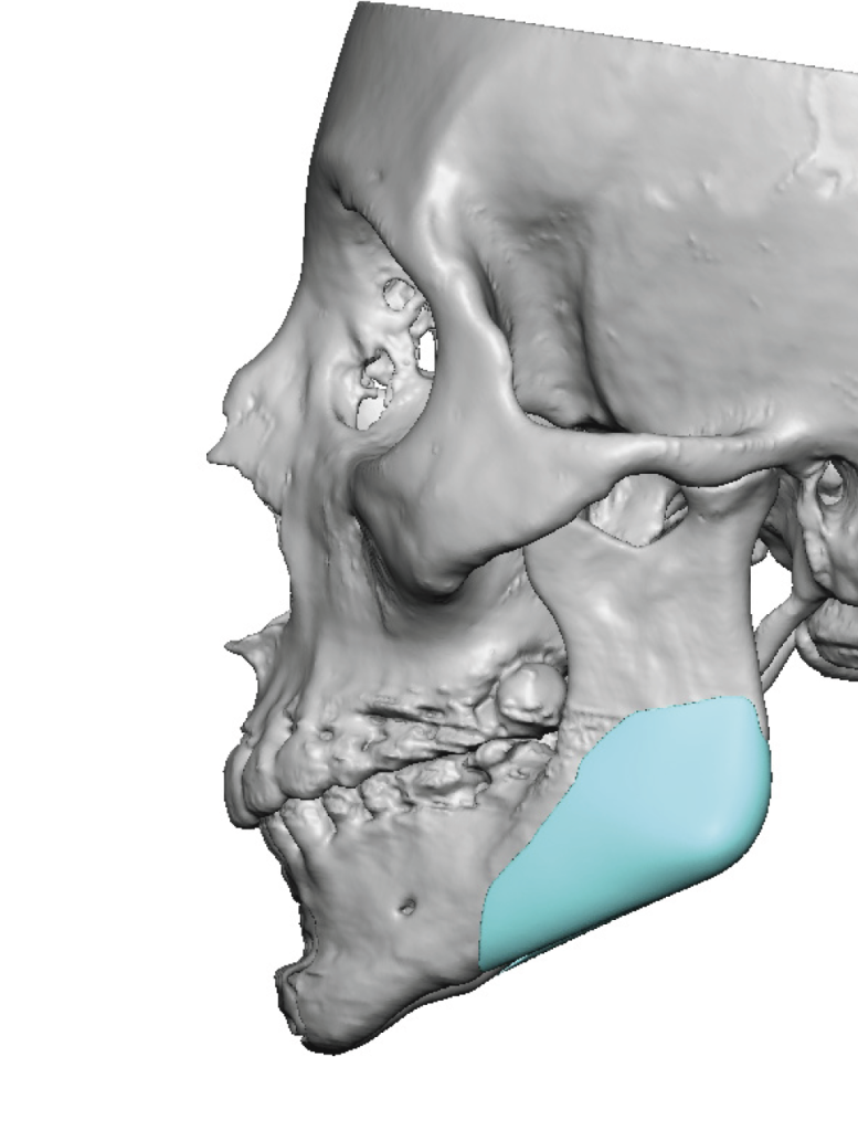 Plastic Surgery Case Study - Custom Jaw Angle Implants For A Complete ...