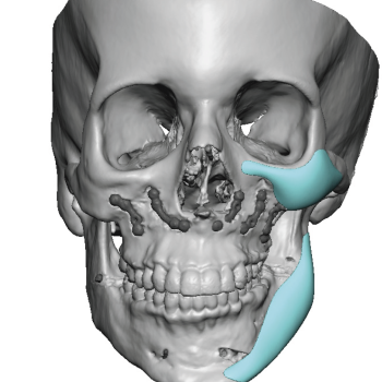 facial asymmetry surgery Archives - Explore Plastic Surgery