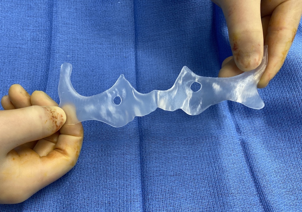 Plastic Surgery Case Study Extended Custom Midface Implant for a