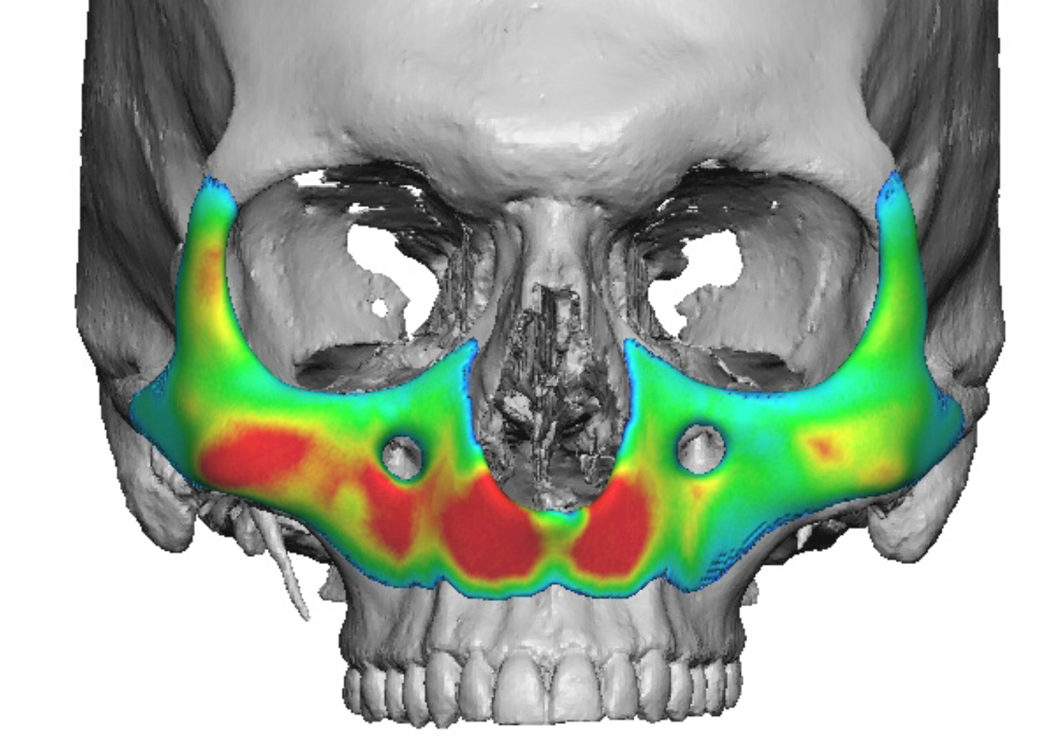 Plastic Surgery Case Study Extended Custom Midface Implant for a