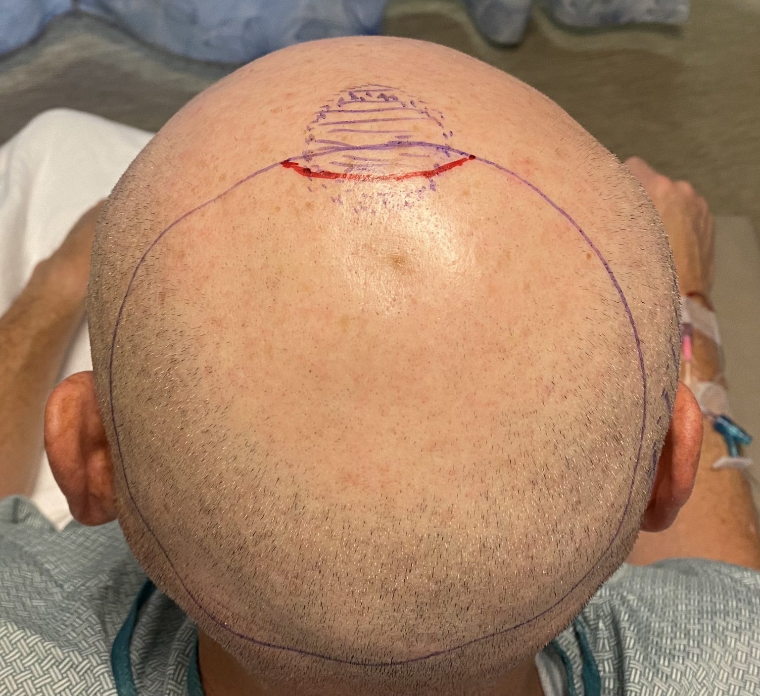 Flat Back Of Head Surgical Markings Back View Dr Barry ERppley 1536x1407 