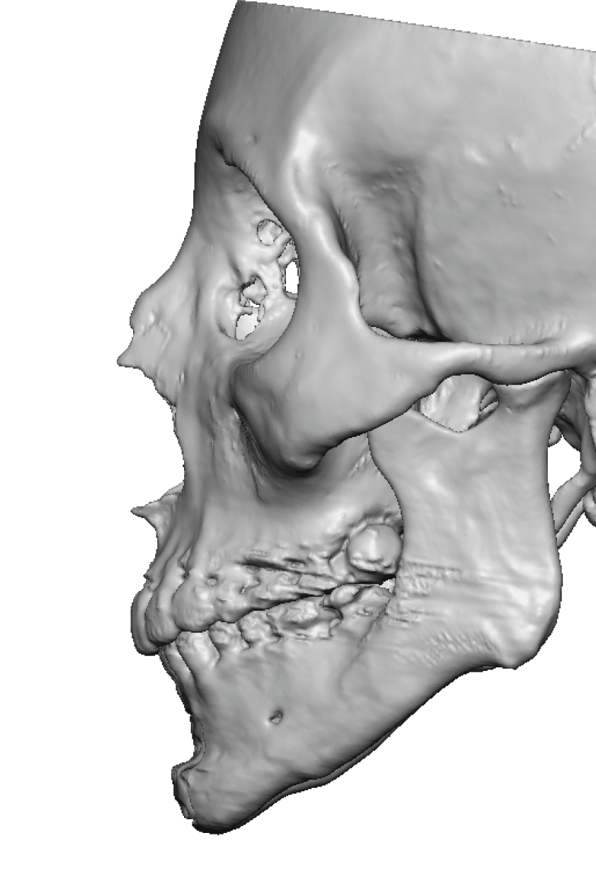 high jaw angles after sliding genioplasty 3D CT scan side view Dr ...