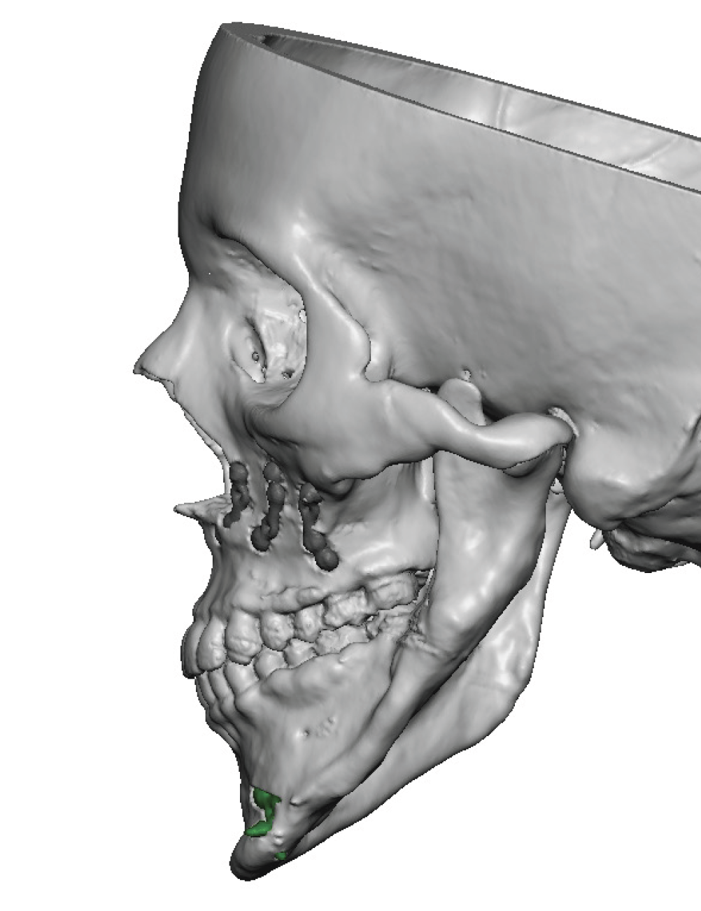 Plastic Surgery Case Study - Custom Left Cheek And Jaw Implants In 