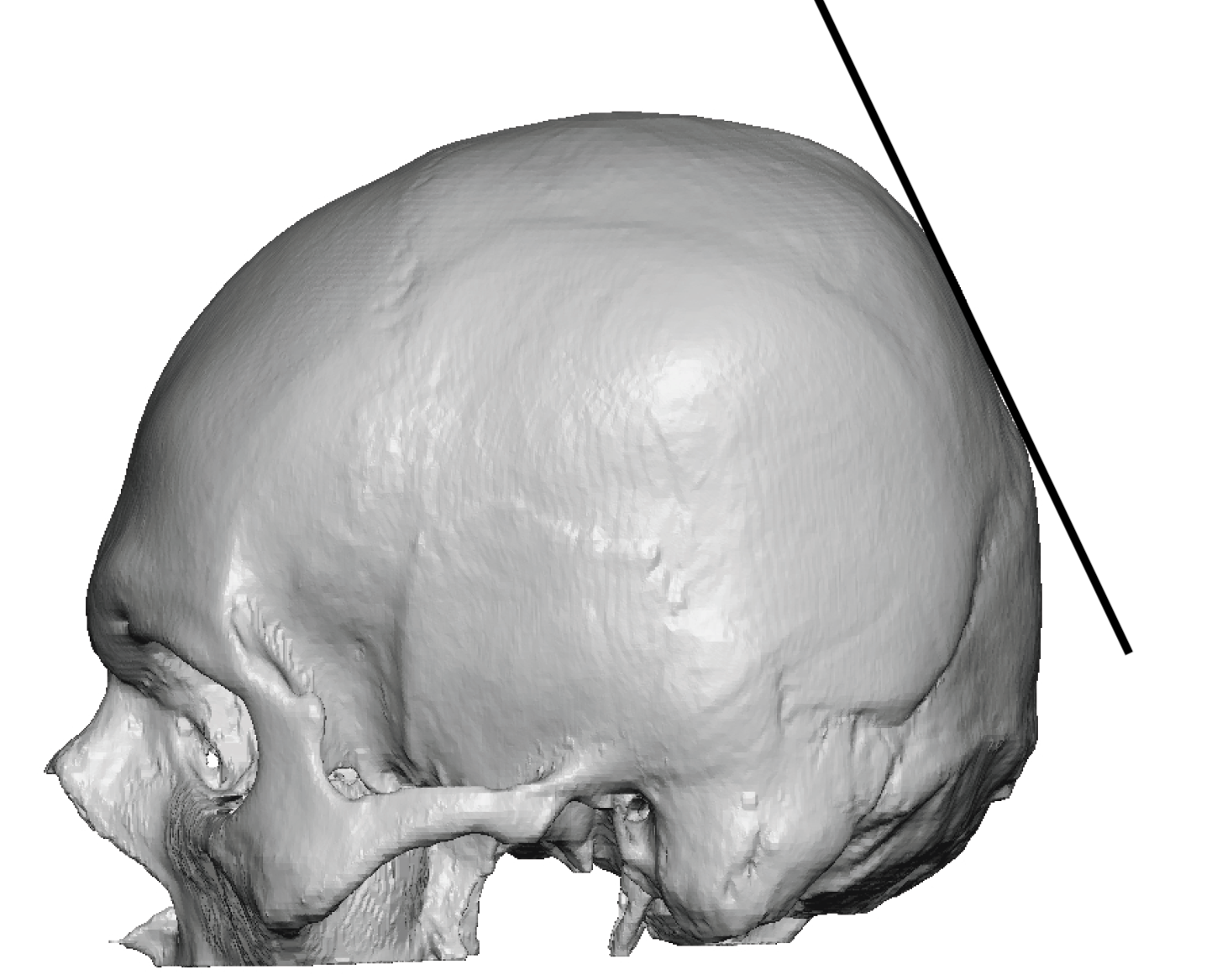 Plastic Surgery Case Study - The Angular Projecting Custom Skull ...