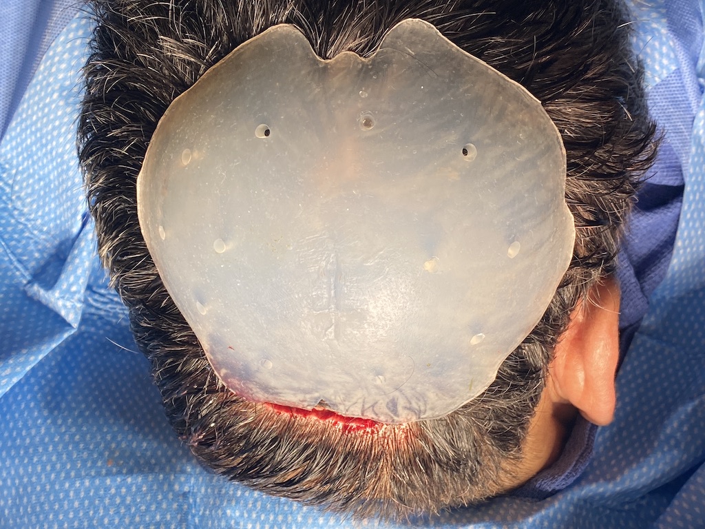 Plastic Surgery Case Study The Angular Projecting Custom Skull Implant For The Flat Back Of