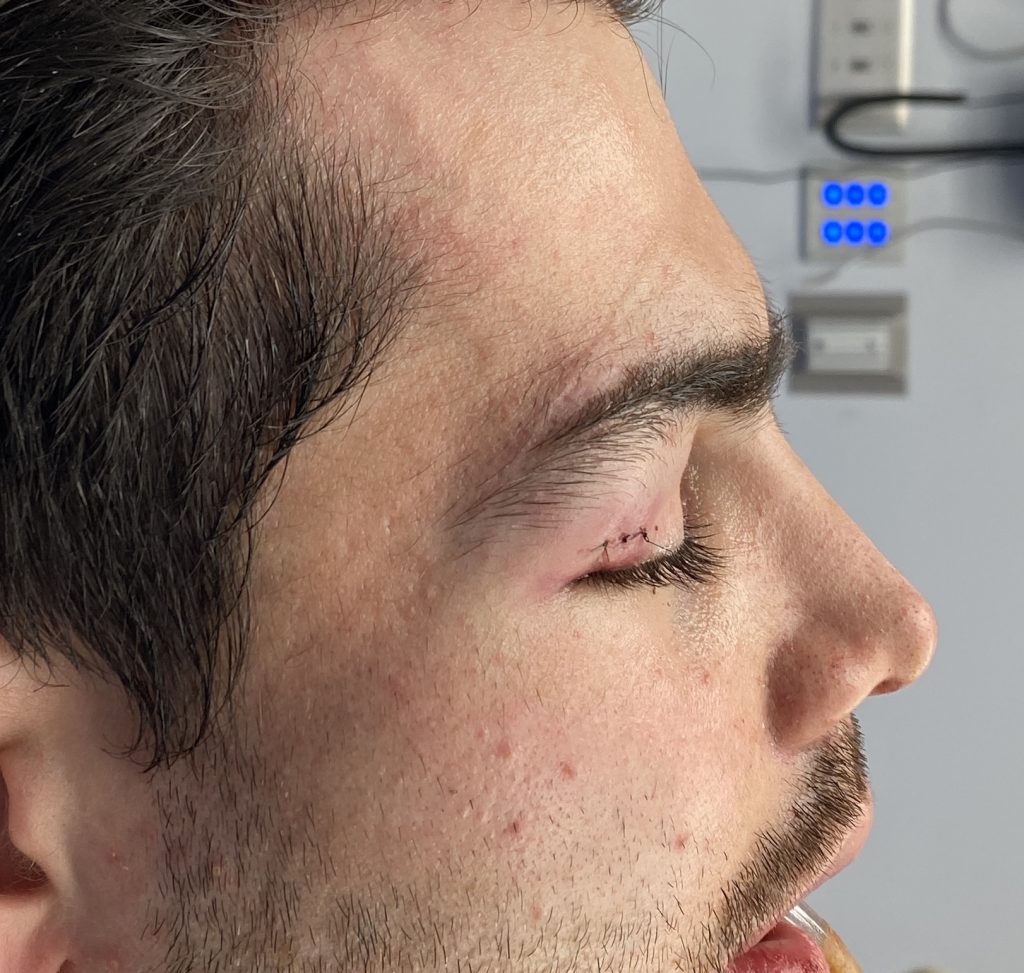 Plastic Surgery Case Study Extended Custom Midface Implant for a