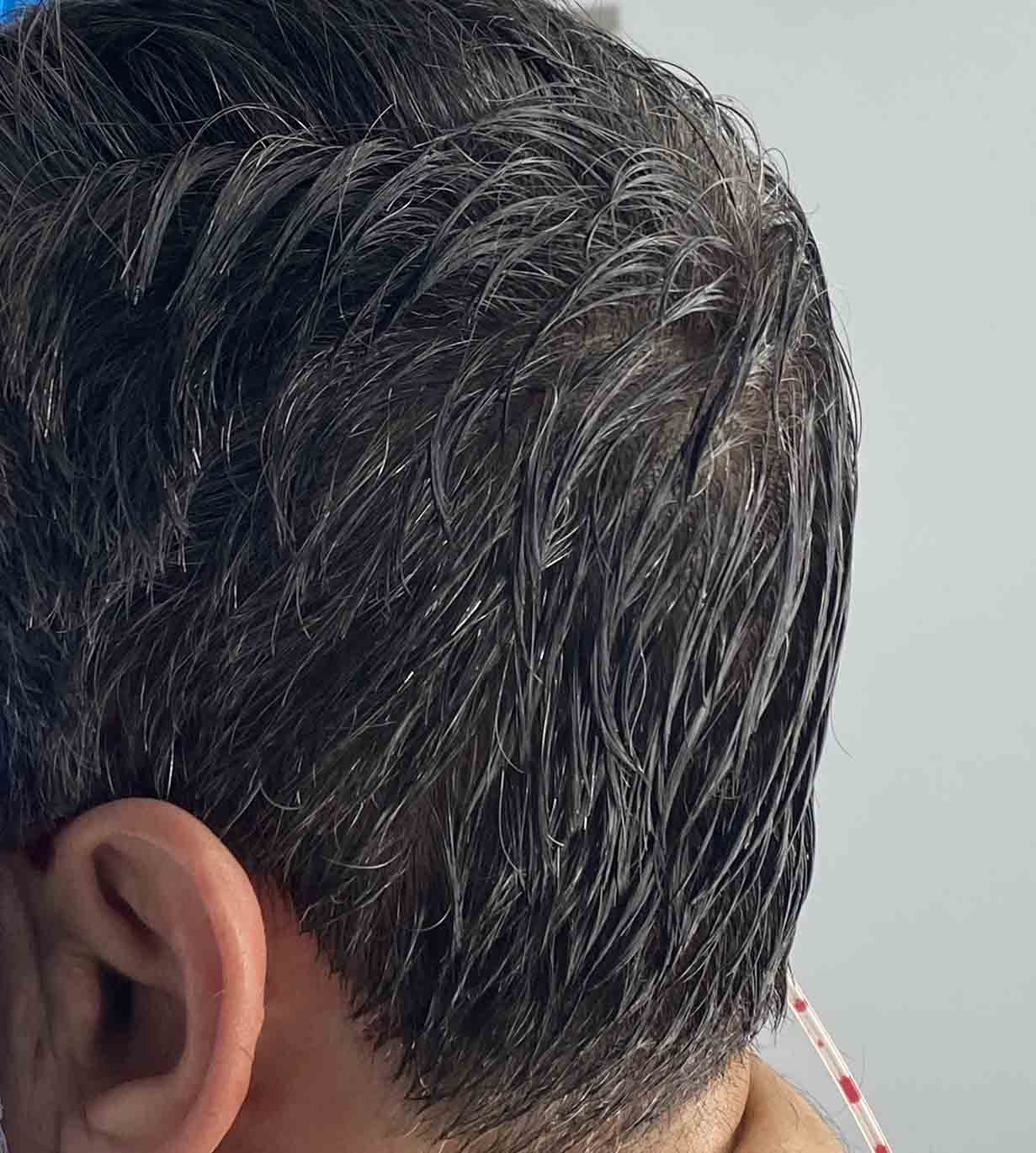 Plastic Surgery Case Study The Angular Projecting Custom Skull