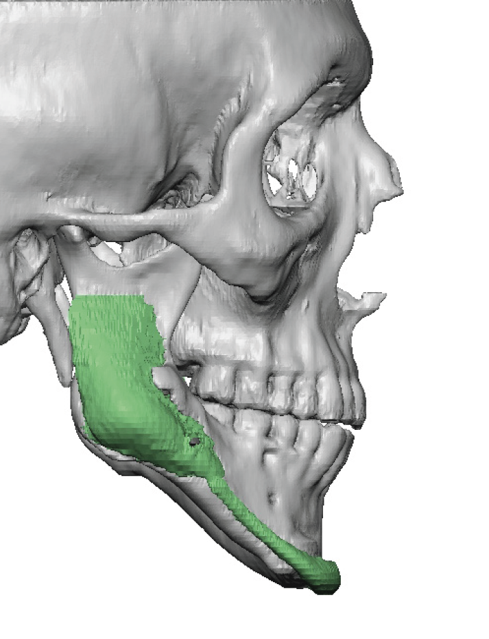 Plastic Surgery Case Study - Custom Jawline Implant Replacement for ...