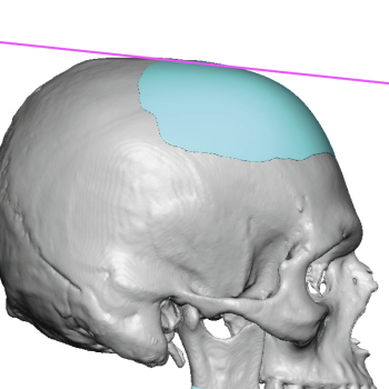 skull reshaping Archives - Explore Plastic Surgery