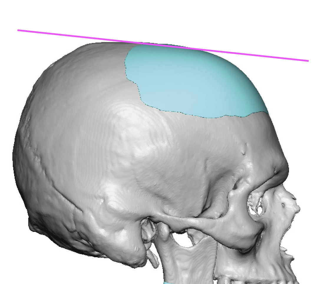 Plastic Surgery Case Study Correction Of An Upper Forehead Slope With A Custom Skull Implant And Bone Bump Burring Explore Plastic Surgery