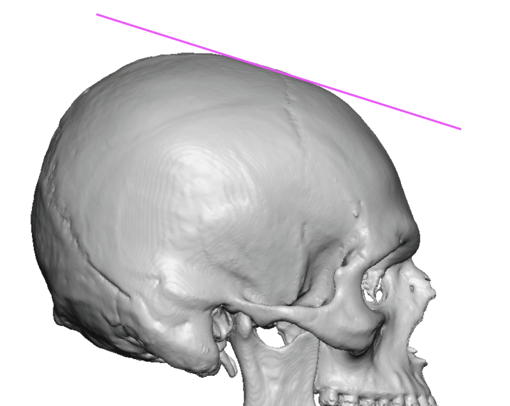 Plastic Surgery Case Study - Correction of an Upper Forehead Slope with ...