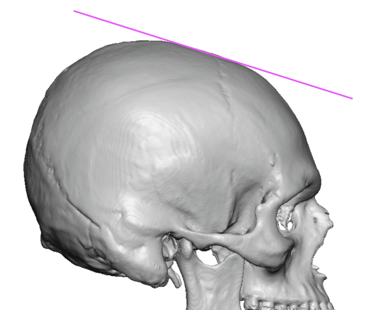skullforehead slope deformity 3D CT scan side view Dr Barry Eppley